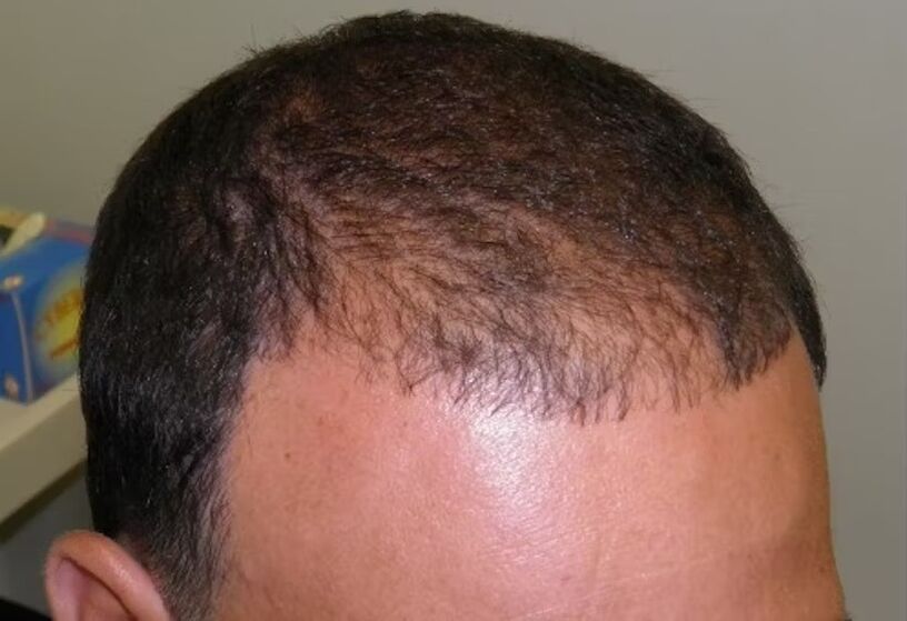 Perte de cheveux avant d'utiliser le verdoxidil