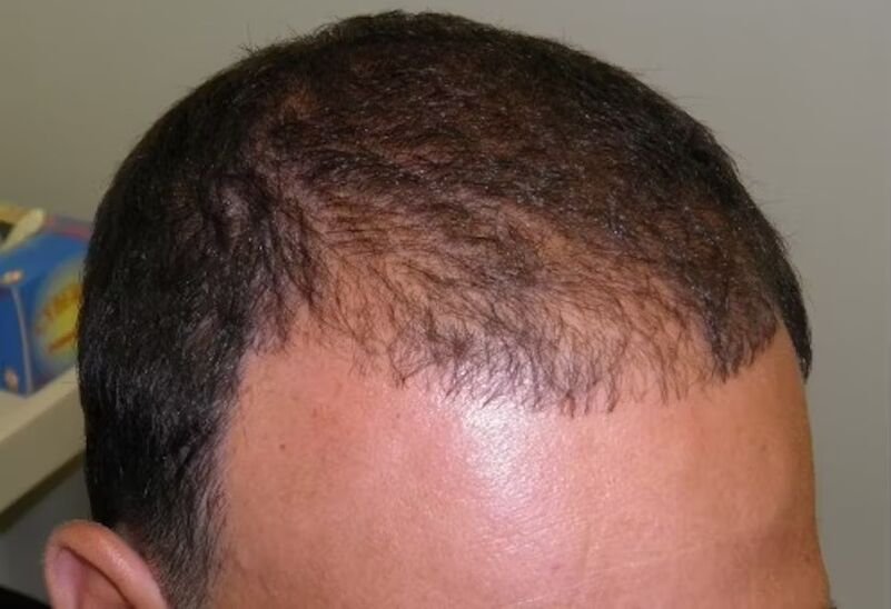 perte de cheveux avant d'utiliser le verdoxidil